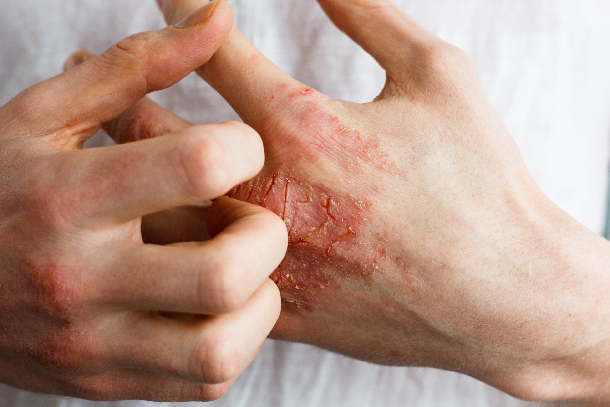 Everything You Need To Know About Managing Eczema SelfDecode Health Everything You Need To Know About Managing Eczema SelfDecode Health